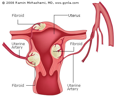 mri guided ultrasound surgery uterine fibroids
