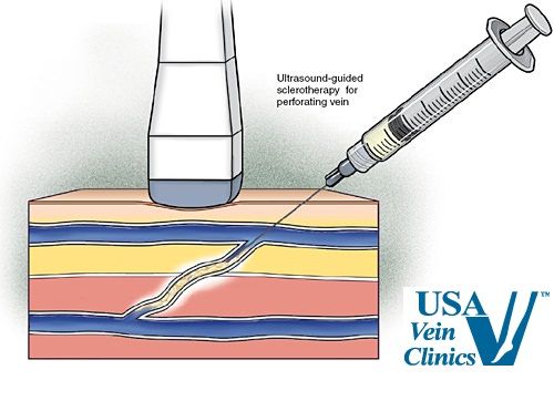 ultrasound guided sclerotherapy side effects